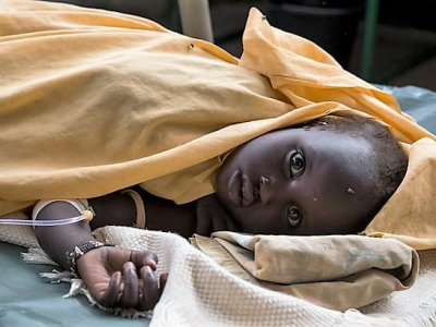 Child with cholera
