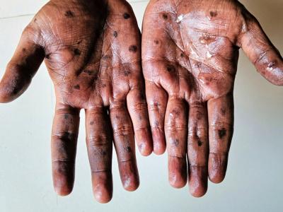 mpox on hands