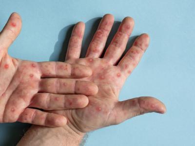 mpox hands