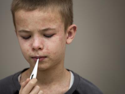 boy with measles