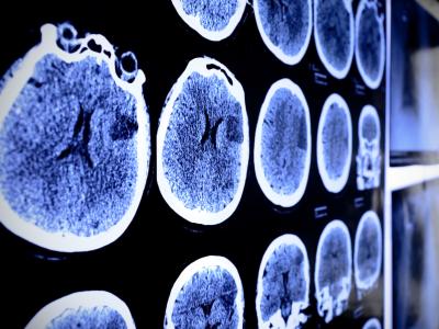brain MRI