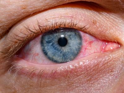 problem solving during covid 19 conjunctivitis