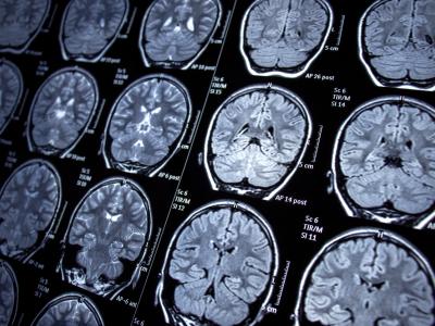 brain MRI