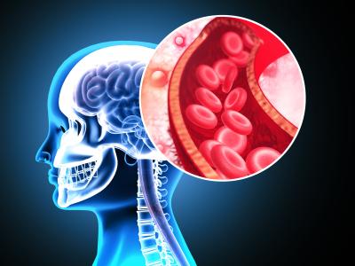 stroke illustration