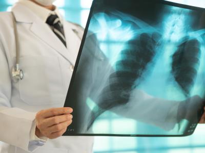 lung cancer