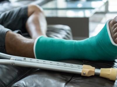 Broken leg in cast