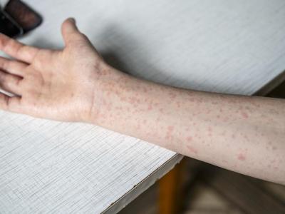 measles rash on arm