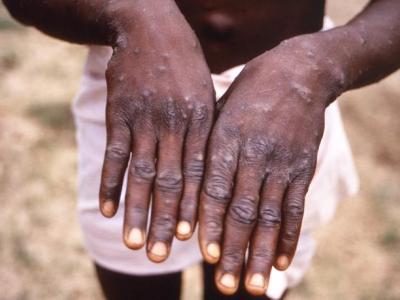 mpox hand lesions