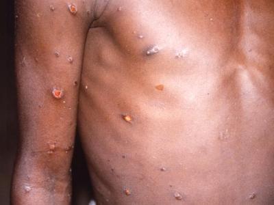 mpox lesions