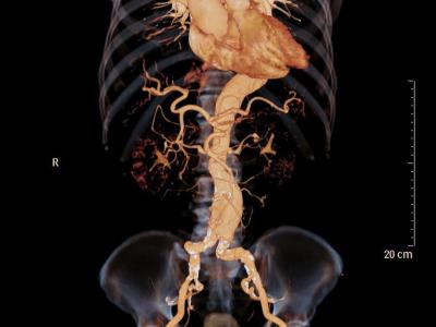 Aortic aneurysm on CT