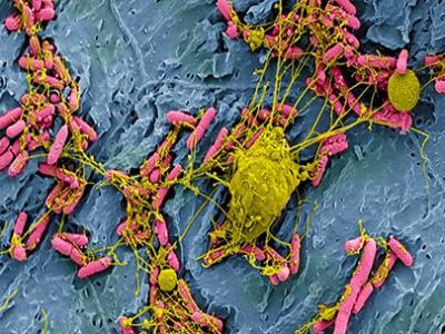 E coli bladder infection