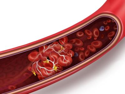 Blood clot in vein