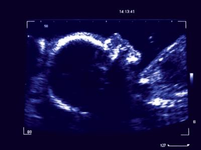 Ultrasound