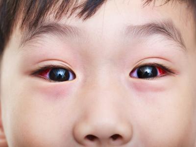 Close-up of boy with conjunctivitis