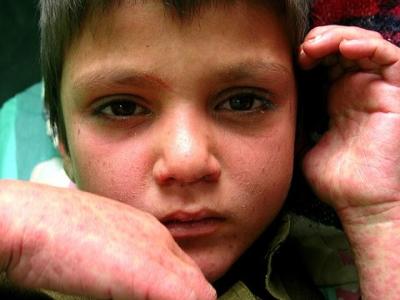 Young boy with measles