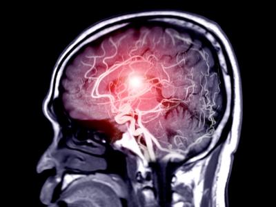 Brain MRI