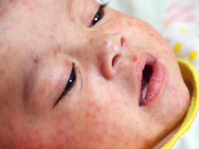Baby with measles