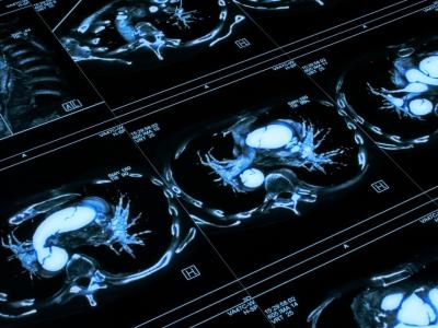 Chest CT scan