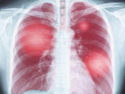 Chest x-ray with lungs shown in red