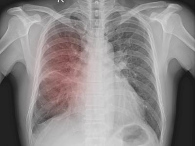 Chest x-ray