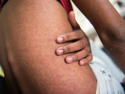 Chik skin rash
