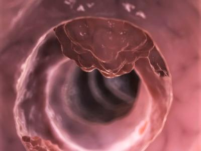 Colon cancer