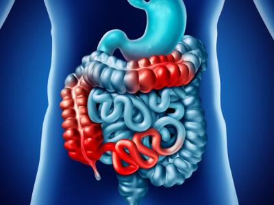 Illustration of Crohn's disease