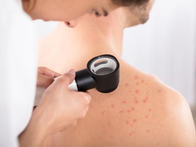 Dermatoscope for acne