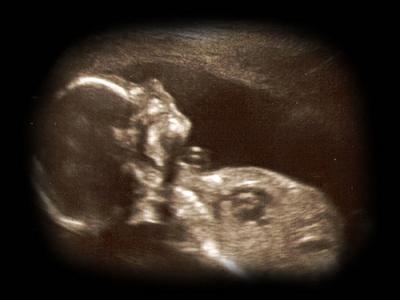 fetal ultrasound