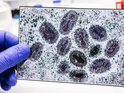 Gloved hand holding photo of monkeypox viruses