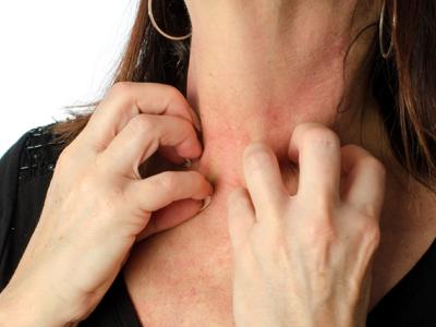 Itchy rash