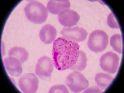 Malaria parasite in blood