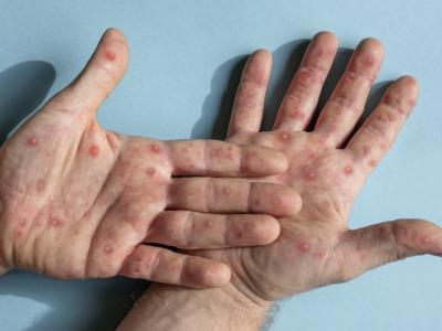 monkeypox hands