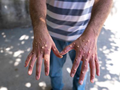 pox hands