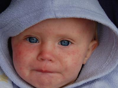 Baby with measles