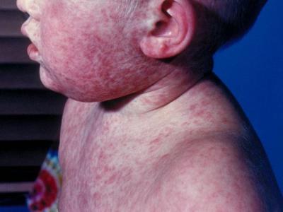 Boy with measles