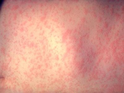 Skin rash in measles patient