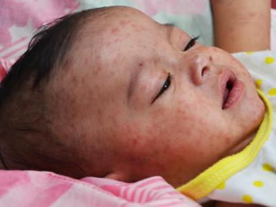 Baby with measles
