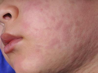 measles child