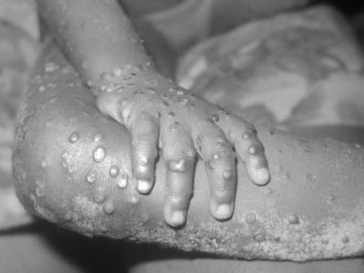 Monkeypox on leg and hand of young girl
