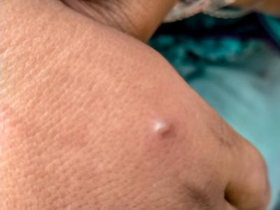 Monkeypox lesion on hand