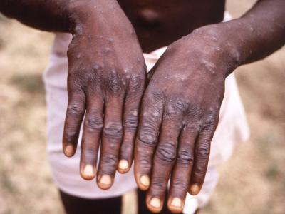 Monkeypox lesions on the back of the hands
