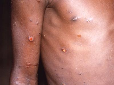 Monkeypox lesions on arm and chest