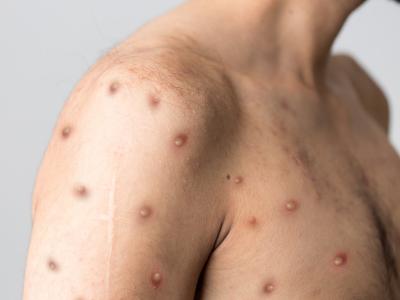Monkeypox lesions on chest and arm