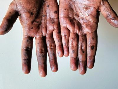 Monkeypox on person's hands