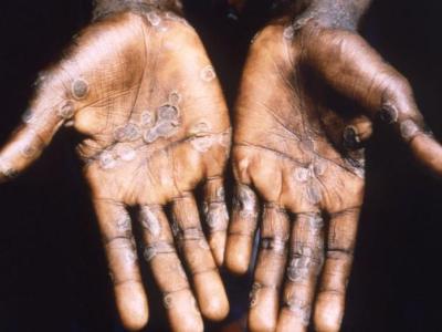 Monkeypox rash on palm of hands