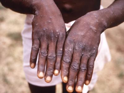 Monkeypox on back of hands