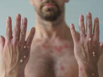 Monkeypox blisters on man's hands and chest