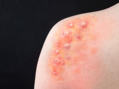 Monkeypox blisters on shoulder