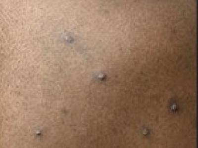 Monkeypox lesions on back and shoulder